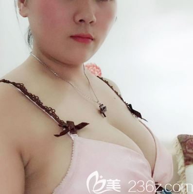 廣東美恩許揚濱奧美定取出和假體隆胸 廣東美恩許揚濱奧美定取出和假體隆胸