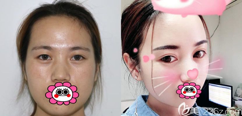 李繼鵬雙眼皮案例