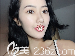 劉彥龍做雙眼皮怎么樣 劉彥龍做雙眼皮怎么樣