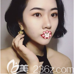 重慶藝星整形雙眼皮加自體脂肪面部填充術(shù)后2個月 重慶藝星整形雙眼皮加自體脂肪面部填充術(shù)后2個月