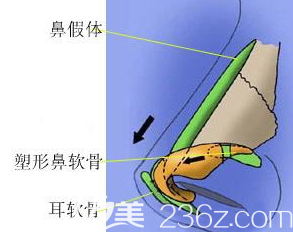 除去自體吸收的部分鼻綜合總體來說可以達(dá)到一個(gè)的效果