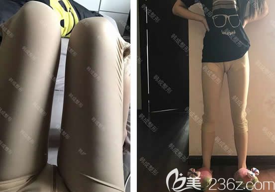 我在南寧韓成整形做大腿360環(huán)吸第3天