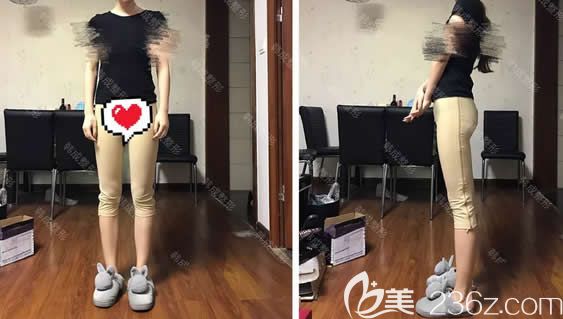 我在南寧韓成整形做大腿環(huán)形吸脂第10天