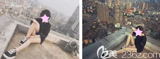 這是我在南寧韓成整形做大腿360環(huán)形吸脂后1-300天恢復(fù)過程圖，竟然沒有反彈哦