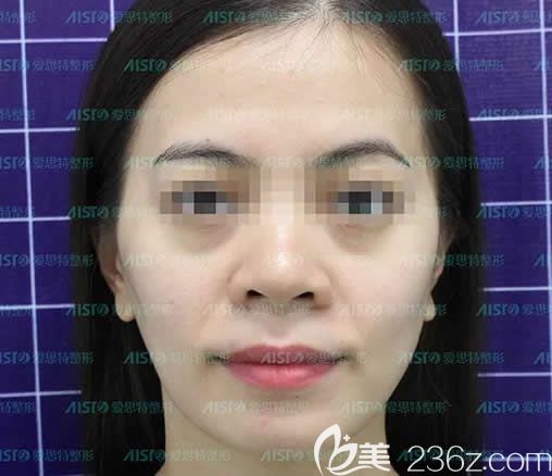 我在南寧愛思特整形做面部填充前的照片 我在南寧愛思特整形做面部填充前的照片