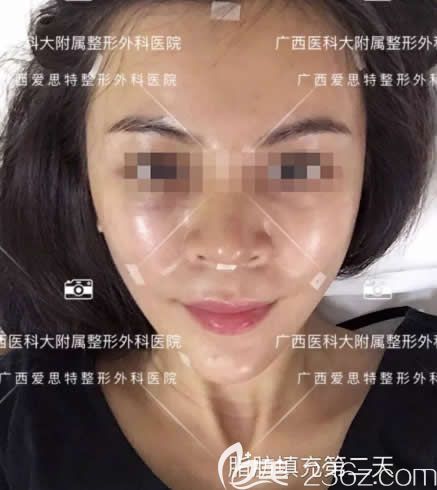 我在南寧愛思特整形做全臉自體脂肪填充第2天 我在南寧愛思特整形做全臉自體脂肪填充第2天