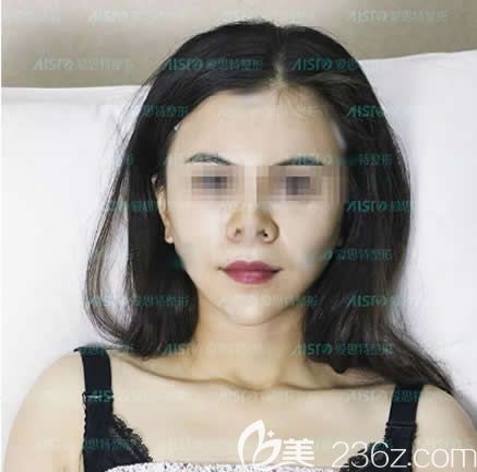 面部填充是脂肪好還是玻尿酸好？圍觀我在南寧愛(ài)思特整形做全臉自體脂肪填充第5天消腫照片