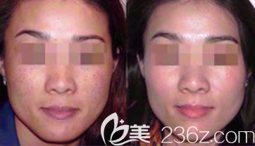 南寧韓成整形韋娉婷主任激光祛斑案例