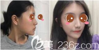醫(yī)院整形美容科楊苓山鼻綜合真人案例 醫(yī)院整形美容科楊苓山鼻綜合真人案例
