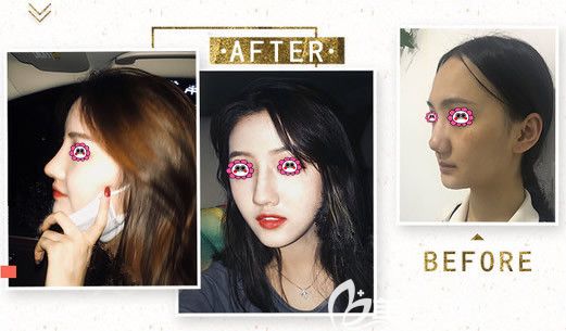 畫美整形醫(yī)院隆鼻變化圖