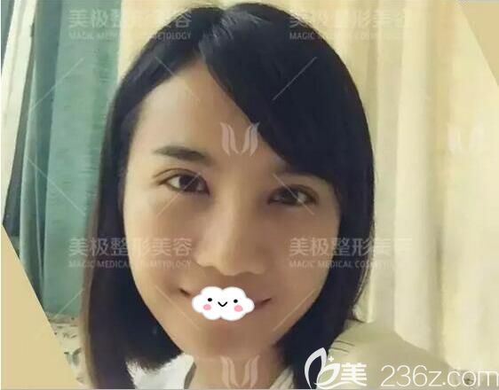 雙眼皮+假體隆鼻術(shù)后15天效果 雙眼皮+假體隆鼻術(shù)后15天效果