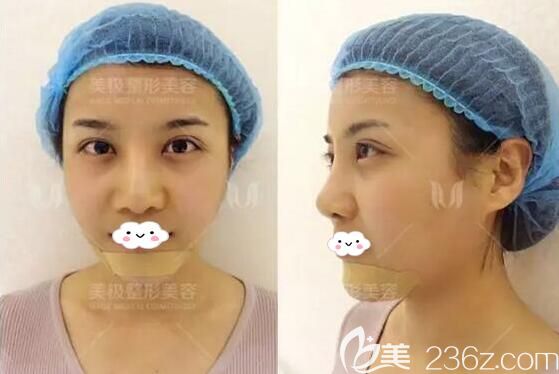 成都美極假體墊下巴術(shù)后即刻 成都美極假體墊下巴術(shù)后即刻