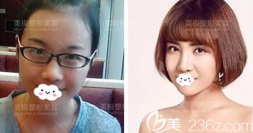 成都美極雙眼皮隆鼻豐下巴術(shù)后對比 成都美極雙眼皮隆鼻豐下巴術(shù)后對比