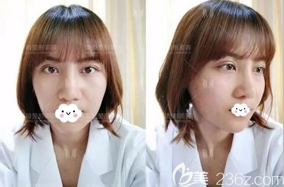 假體隆下巴術(shù)后7天效果 假體隆下巴術(shù)后7天效果