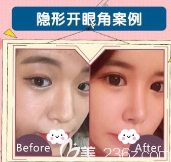 荊州華美李杰雙眼皮+開內(nèi)眼角真人案例 荊州華美李杰雙眼皮+開內(nèi)眼角真人案例