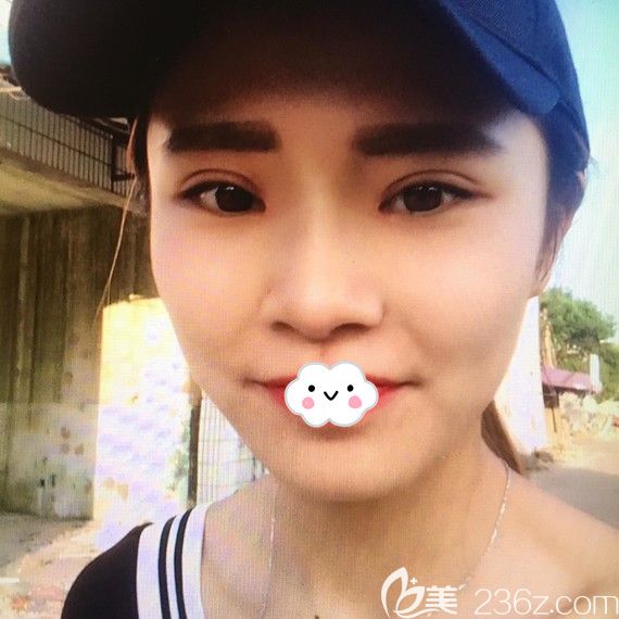 荊州華美<!--<i data=20240703-sp></i>-->眼綜合+假體隆鼻案例術(shù)后效果