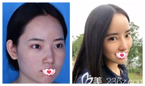 2019年秦皇島念奴嬌春節(jié)整形優(yōu)惠活動已經(jīng)上線 雙眼皮、隆鼻特價項目讓你超值變美