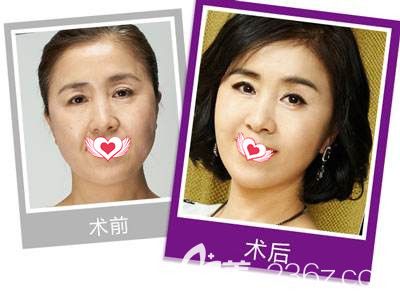 秦皇島念奴嬌做除皺案例