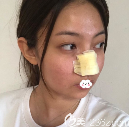 荊州華美李杰隆鼻失敗修復(fù)術(shù)后2天效果