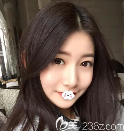 荊州華美李杰隆鼻失敗修復(fù)整形案例