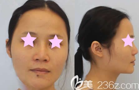 我在南寧夢(mèng)想整形做面部填充前的照片 我在南寧夢(mèng)想整形做面部填充前的照片