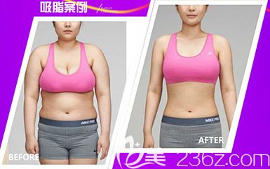 張家港康麗整形醫(yī)院全身吸脂對比圖