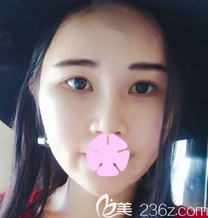 這是我在南寧夢想整形做全臉自體脂肪填充親身經(jīng)歷及術(shù)前術(shù)后對比圖，可以美美噠過年啦