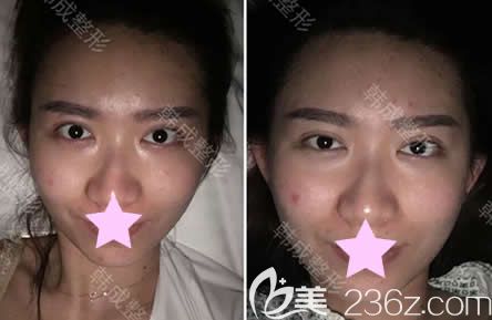 我在南寧韓成做面部線雕除皺當天