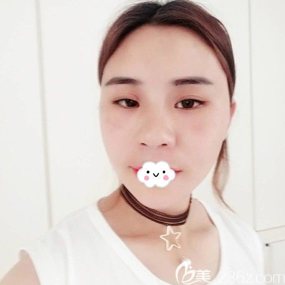 荊州華美自體脂肪面部填充術(shù)后恢復(fù)效果圖