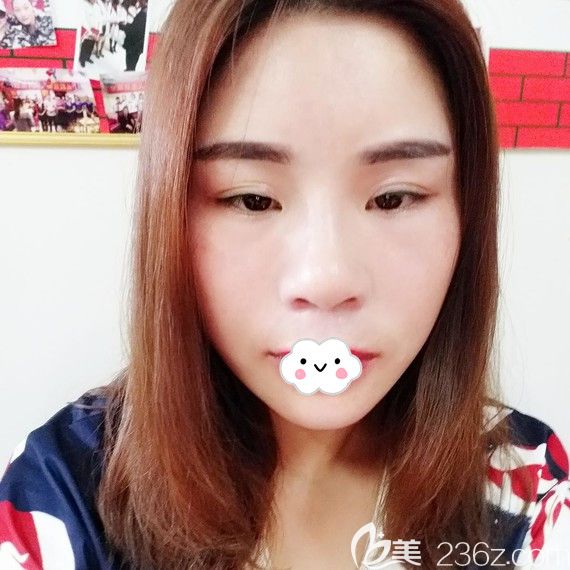 荊州華美自體脂肪面部填充效果怎么樣？看真人案例