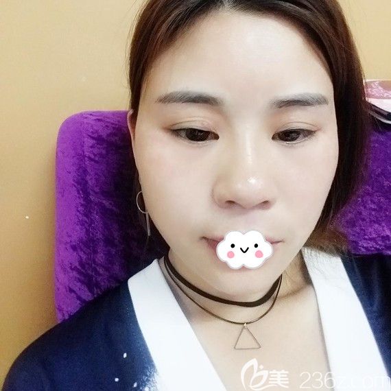 花1W多價(jià)格在荊州華美做自體脂肪面部填充30天恢復(fù)效果照片在這里