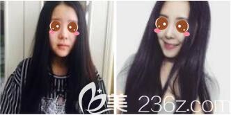 醫(yī)院整形美容科呂敏鼻綜合真人案例 醫(yī)院整形美容科呂敏鼻綜合真人案例