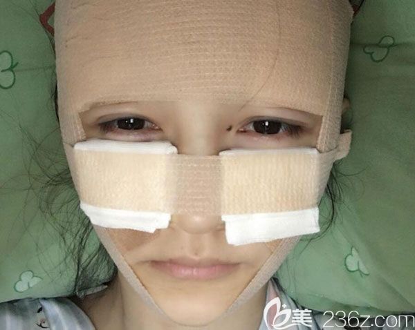 面部自體脂肪填充第2天沒(méi)有發(fā)現(xiàn)創(chuàng)傷和切口 面部自體脂肪填充第2天沒(méi)有發(fā)現(xiàn)創(chuàng)傷和切口