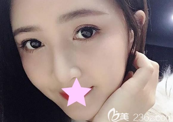 自體脂肪面部填充一個(gè)月恢復(fù)效果圖 自體脂肪面部填充一個(gè)月恢復(fù)效果圖