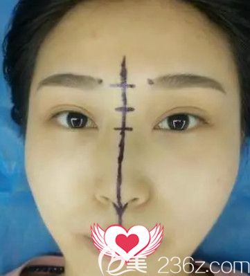 巧致整形醫(yī)院任加偉醫(yī)生做假體隆鼻前鼻子塌平 巧致整形醫(yī)院任加偉醫(yī)生做假體隆鼻前鼻子塌平