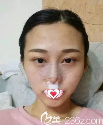 任加偉醫(yī)生為我剛做完隆鼻術(shù)后鼻子微腫 任加偉醫(yī)生為我剛做完隆鼻術(shù)后鼻子微腫