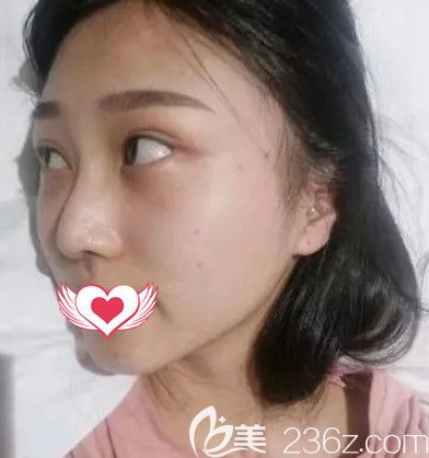 在秦皇島巧致做假體隆鼻術(shù)后7天進(jìn)行拆線 在秦皇島巧致做假體隆鼻術(shù)后7天進(jìn)行拆線