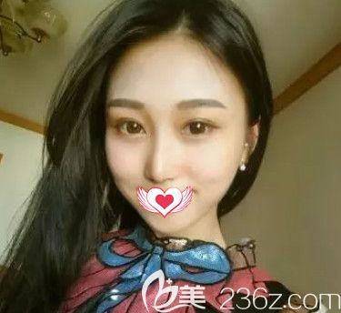 任加偉醫(yī)生為我做硅膠隆鼻18天鼻子完全消腫 任加偉醫(yī)生為我做硅膠隆鼻18天鼻子完全消腫