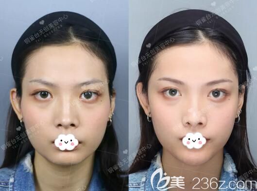 玻尿酸豐太陽穴術后正面對比