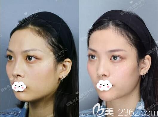 玻尿酸填充下巴術后側臉對比