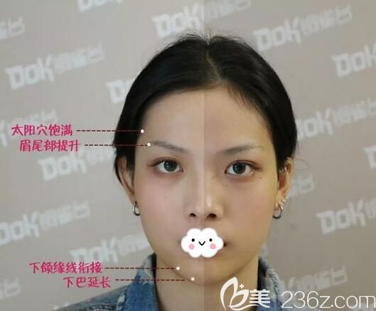 玻尿酸填充太陽穴、下巴半邊臉對比