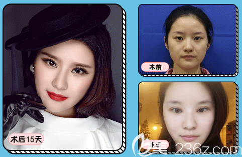 深圳鵬程整形醫(yī)院李子鵬雙眼皮<span style= 深圳鵬程整形醫(yī)院李子鵬雙眼皮<span style=