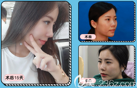 深圳鵬程醫(yī)院整形科李子鵬做的隆鼻<span style= 深圳鵬程醫(yī)院整形科李子鵬做的隆鼻<span style=