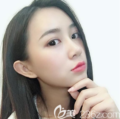 深圳鵬程醫(yī)院李子鵬隆鼻案例 深圳鵬程醫(yī)院李子鵬隆鼻案例