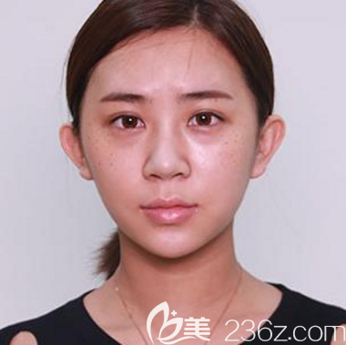 深圳鵬程醫(yī)院隆鼻案例術前照片 深圳鵬程醫(yī)院隆鼻案例術前照片