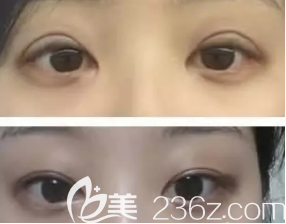 榮成威海孫漫整形診所雙眼皮案例 榮成威海孫漫整形診所雙眼皮案例