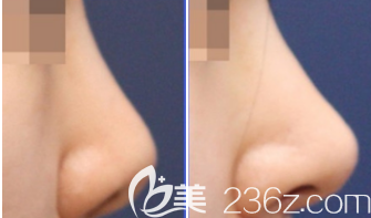 榮成威海孫漫整形診所隆鼻案例 榮成威海孫漫整形診所隆鼻案例