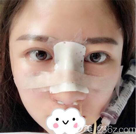 成都銅雀臺<!--<i data=20240703-sp></i>-->隆鼻術(shù)后即刻 成都銅雀臺<!--<i data=20240703-sp></i>-->隆鼻術(shù)后即刻