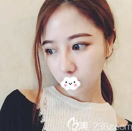 成都銅雀臺<!--<i data=20240703-sp></i>-->肋軟骨鼻綜合術(shù)后一年 成都銅雀臺<!--<i data=20240703-sp></i>-->肋軟骨鼻綜合術(shù)后一年