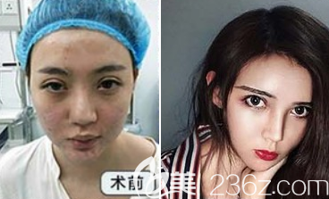 自體脂肪填充案例